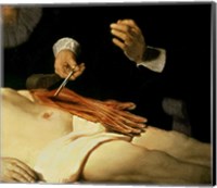 Framed Anatomy Lesson of Dr. Nicolaes Tulp, 1632 (arm detail)